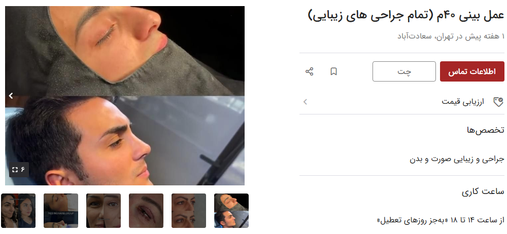 عمل بینی در ایران