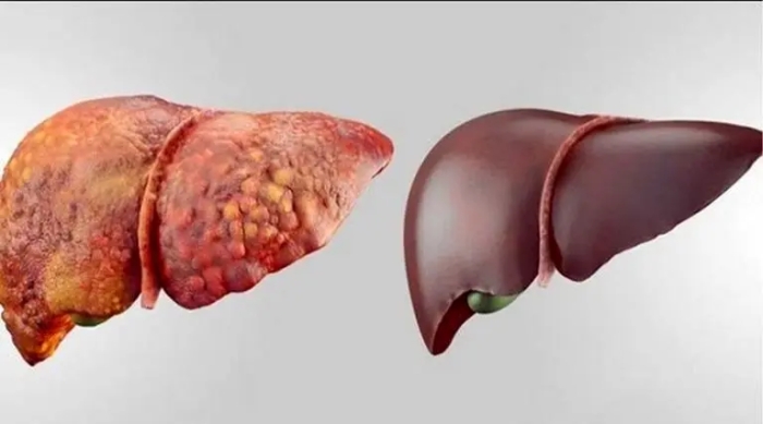 راه قطعی تشخیص کبد چرب کدام است؟ آزمایش یا سونوگرافی؟