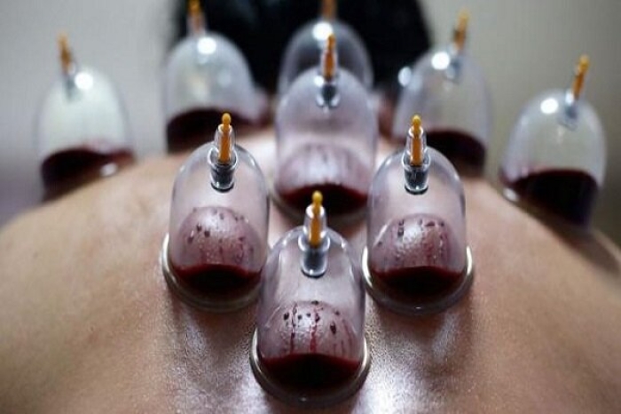 حجامت توسط افراد غیر متخصص خطرناک است