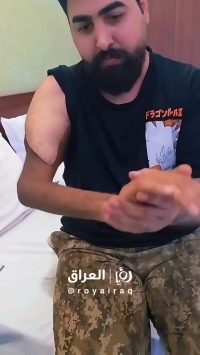 دست یک هندی به بدن نظامی عراقی پیوند زده شد